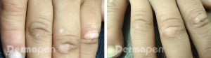 before-after-vitiligo